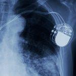 X-ray,Image,Of,Permanent,Pacemaker,Implant,In,Chest,Body,,